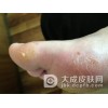 怎样才能不受皲裂疮的骚扰