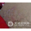 股癣有哪些发病症状