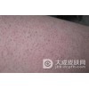 毛囊角化病有哪些临床表现
