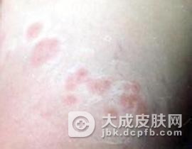 硬红斑的主要症状有什么?