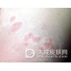 硬红斑的主要症状有什么?