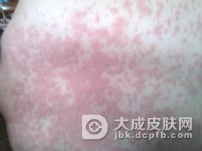 季节性皮肤过敏有何表现