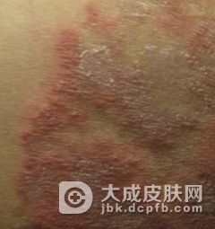股癣发病特点有哪些