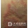 股癣发病特点有哪些