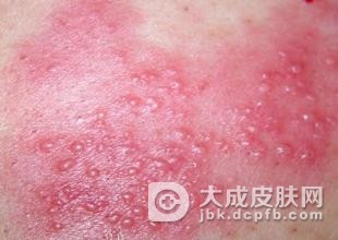 夏天生殖器疱疹患者该怎么护理？