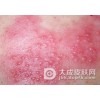 夏天生殖器疱疹患者该怎么护理？
