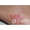 男性生殖器疱疹的检查包括哪些
