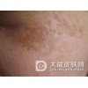平日做好这些就可缓解黄褐斑