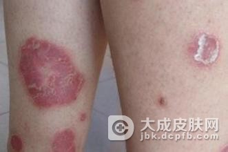 玫瑰糠疹最大的危害是什么