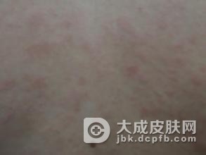 怎样预防小孩得玫瑰糠疹