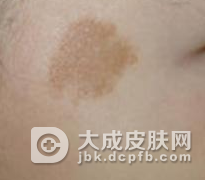 女性脸上出现咖啡斑怎么去除