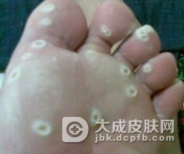 跖疣症状该如何诊断呢