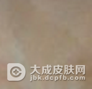 咖啡斑激光后还会继续长出来吗