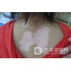 吃什么对白癜风病情比较有好处呢