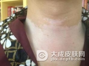 白癜风患者怎样才能护理好皮肤