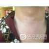 白癜风患者怎样才能护理好皮肤