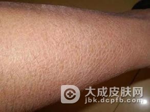 鱼鳞病症状表现是什么