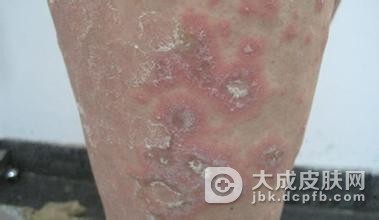 胳膊皮肤上一点皮疹能确诊为银屑病吗