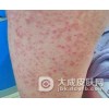 银屑病患者疾病难以治疗是因为什么