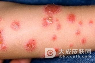 银屑病患者的饮食避免哪些