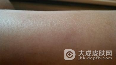 什么方法可以防治鱼鳞病不复发