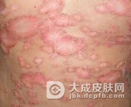 老人银屑病护理有哪些要注意