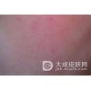 过敏性皮炎患者需补充哪些元素