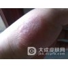 过敏性皮炎发病的最常见症状
