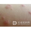 秋季过敏性皮炎护理方法介绍
