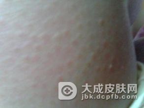 毛囊角化症会遗传给后人吗