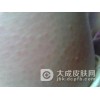 毛囊角化症会遗传给后人吗