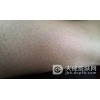 鳞状毛囊角化症的症状有什么?