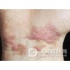 生活中如何避免患上扁平苔癣