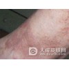 扁平苔癣的介绍与特征