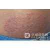 扁平苔癣的预防方法有什么?