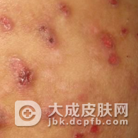 结节性痒疹有哪些主要表现