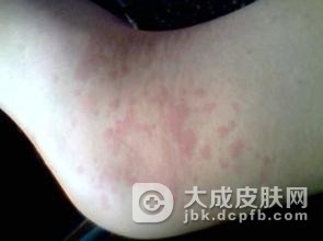 单纯痒疹的病发特点有什么?