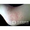 单纯痒疹的病发特点有什么?