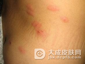单纯性痒疹的症状表现主要有什么?