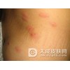 单纯性痒疹的症状表现主要有什么?
