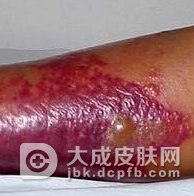 丹毒的中医治疗方法介绍