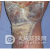 丹毒是如何引发的
