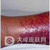 丹毒是如何诱发的