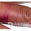 丹毒患者要如何饮食