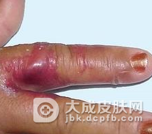 如何预防丹毒的发生
