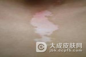 贫血痣的预防保健是什么