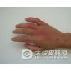 类丹毒的发生是什么原因引起的