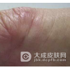 类丹毒的临床症状