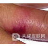 生活中类丹毒是怎样发生的