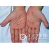 一期梅毒怎样正确护理